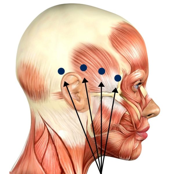 Common Tension Headache Trigger Points - Palestra Boutique Spa