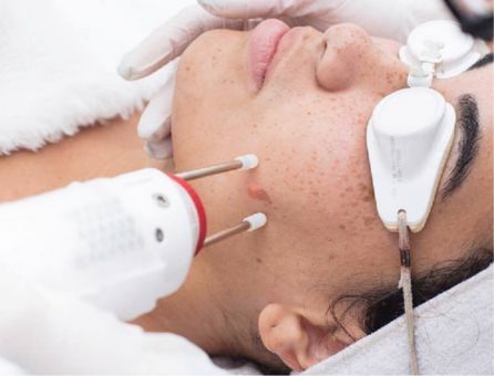 Aerolase Laser Therapy